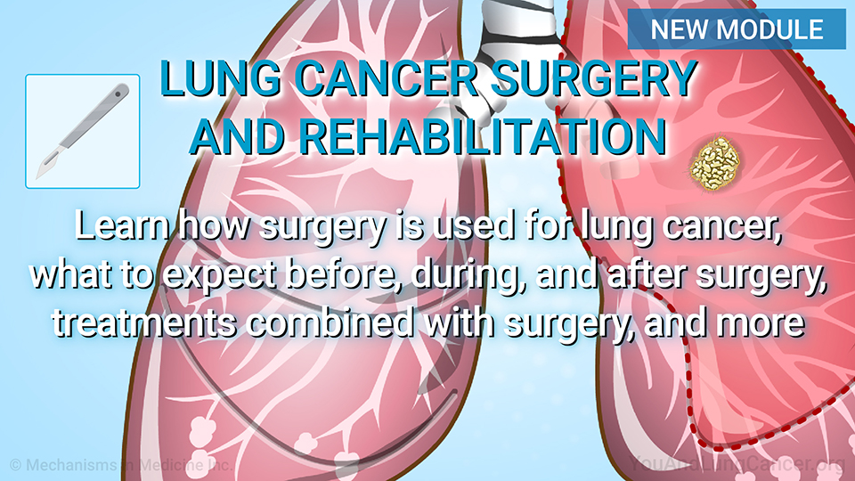 Understanding Lung Cancer Surgery.