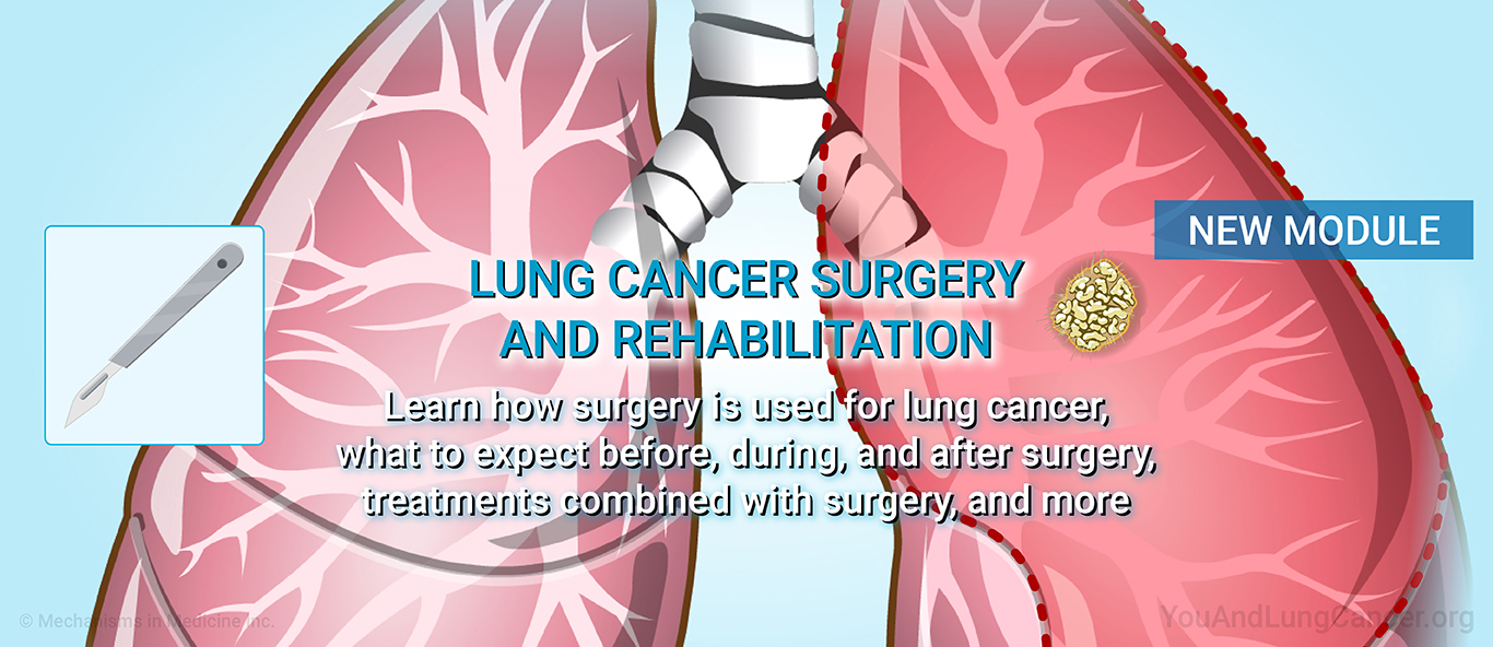Understanding Lung Cancer Surgery.