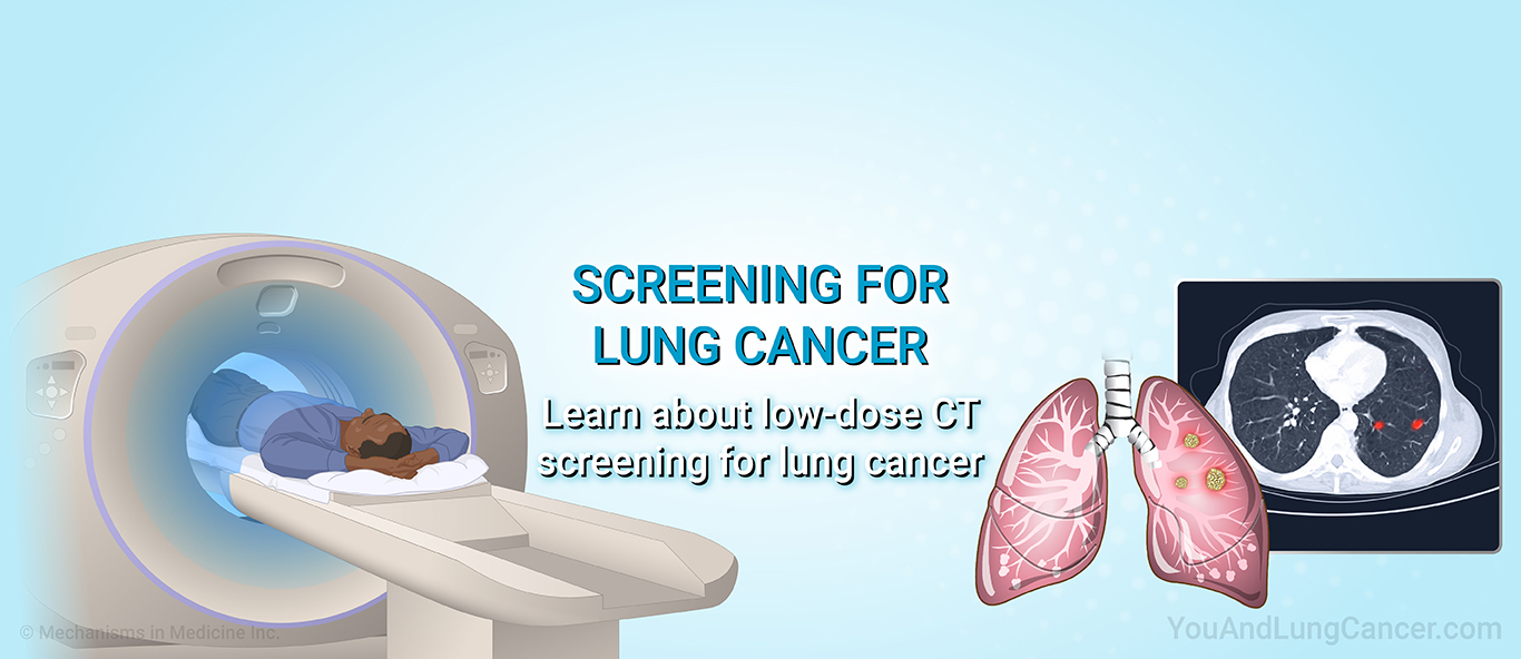 Screening for Lung Cancer. Learn about low-dose CT screening for lung cancer.