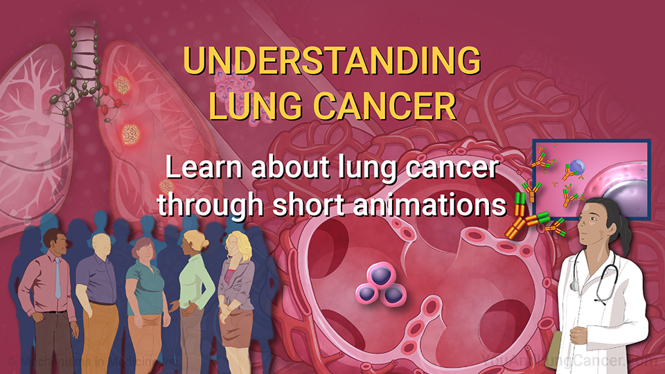 Understanding Lung Cancer. Learn about lung cancer risk factors, symptoms, diagnosis and treatment options through short animations.