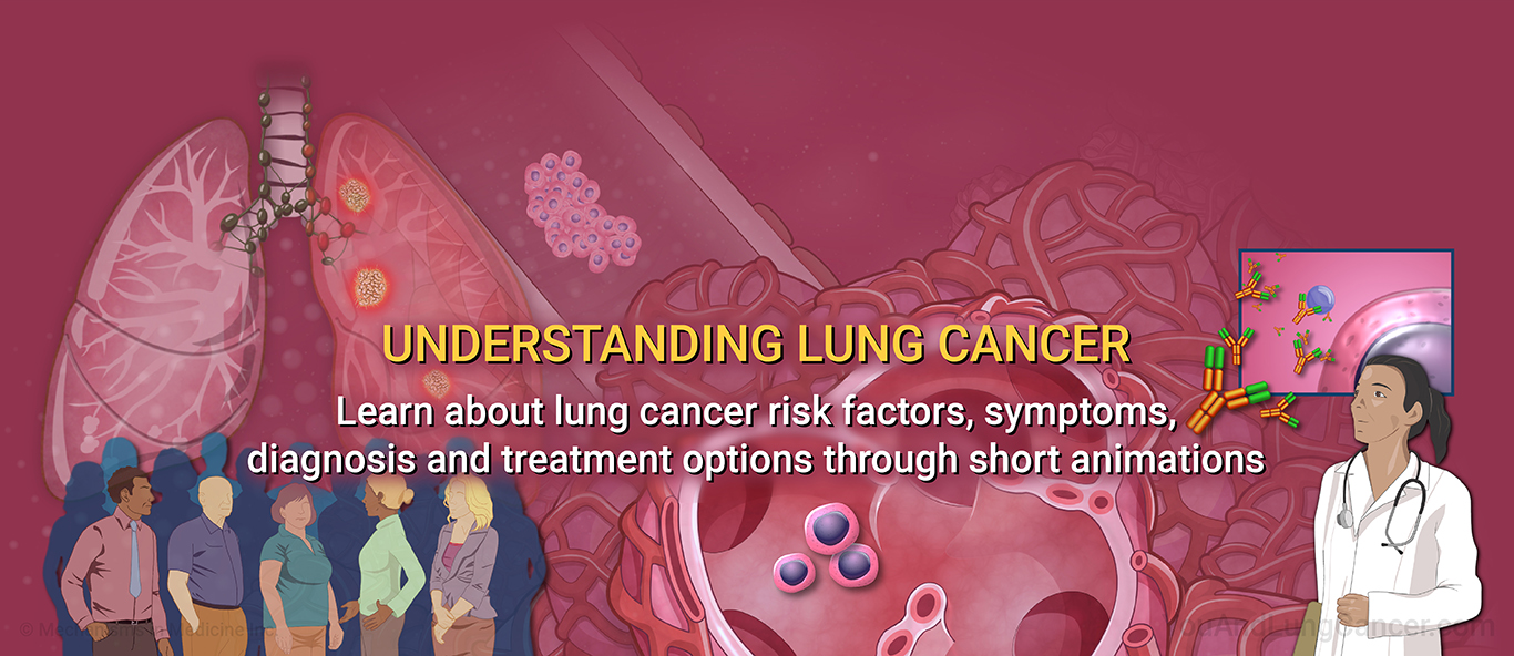 Understanding Lung Cancer. Learn about lung cancer risk factors, symptoms, diagnosis and treatment options through short animations.
