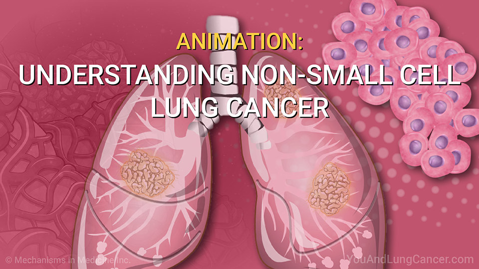 Animation: Understanding Non-Small Cell Lung Cancer.
