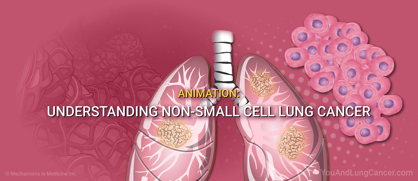 Animation: Understanding Non-Small Cell Lung Cancer.