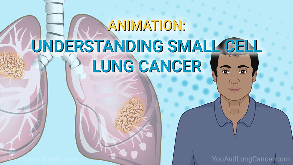 Animation: Understanding Small Cell Lung Cancer.