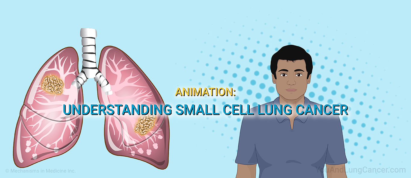 Animation: Understanding Small Cell Lung Cancer.