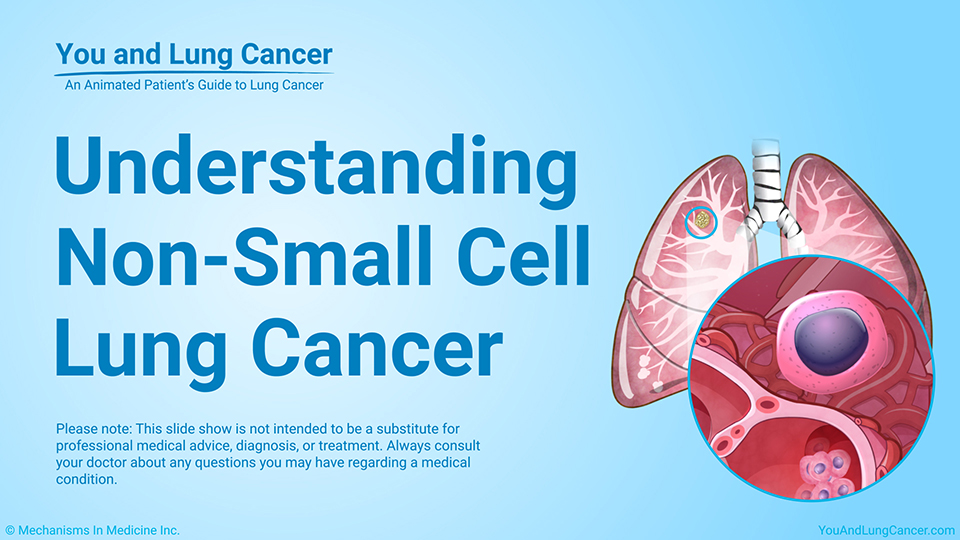 Slide Show - Understanding Non-Small Cell Lung Cancer