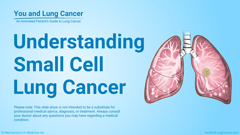Slide Show - Understanding Small Cell Lung Cancer