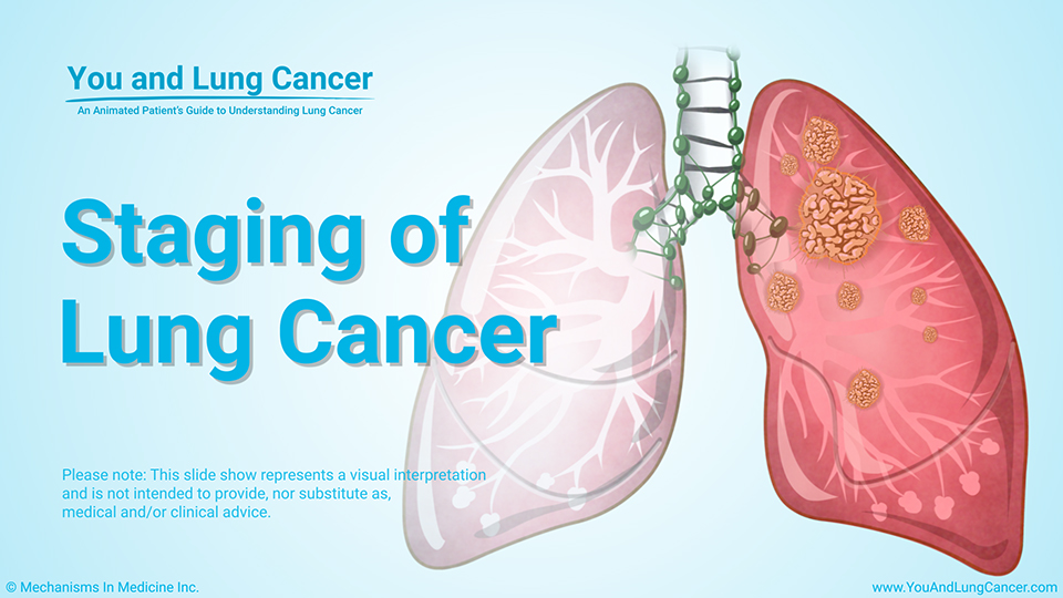 Slide Show - Staging of Lung Cancer