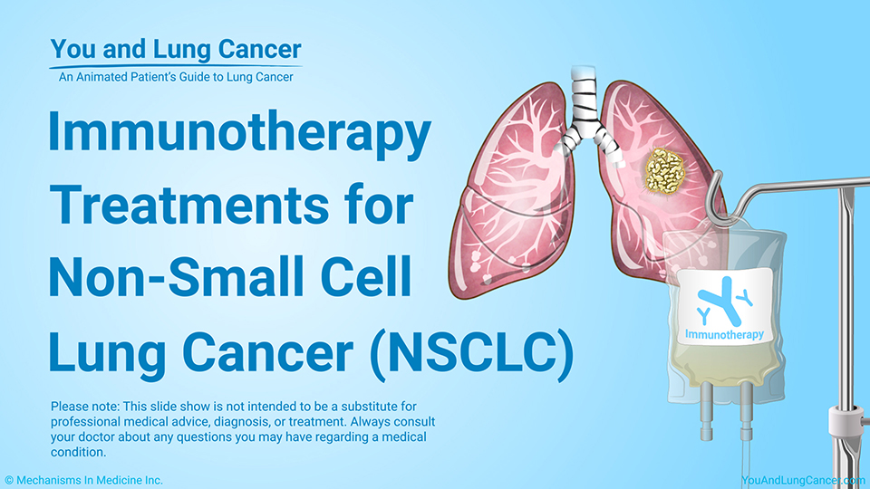 Slide Show - Immunotherapy Treatments for NSCLC
