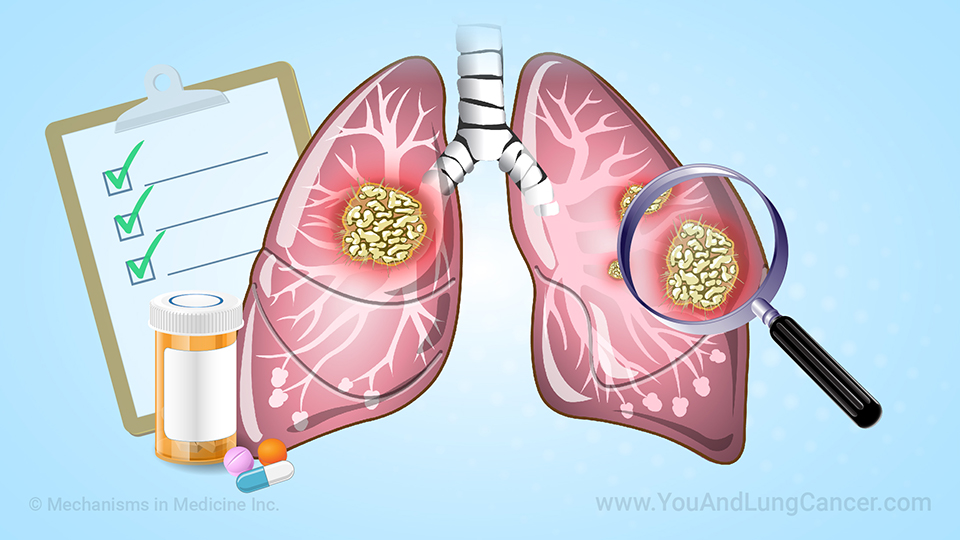 Animation - Understanding Clinical Trials in Lung Cancer