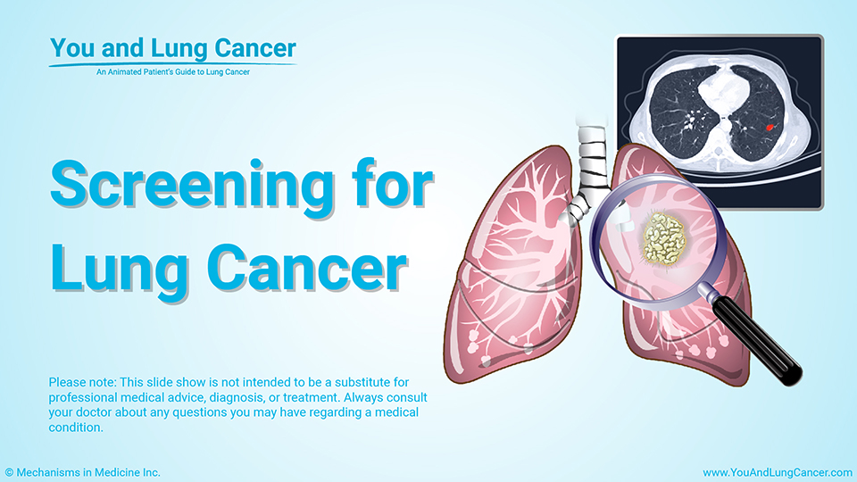 Slide Show - Screening for Lung Cancer