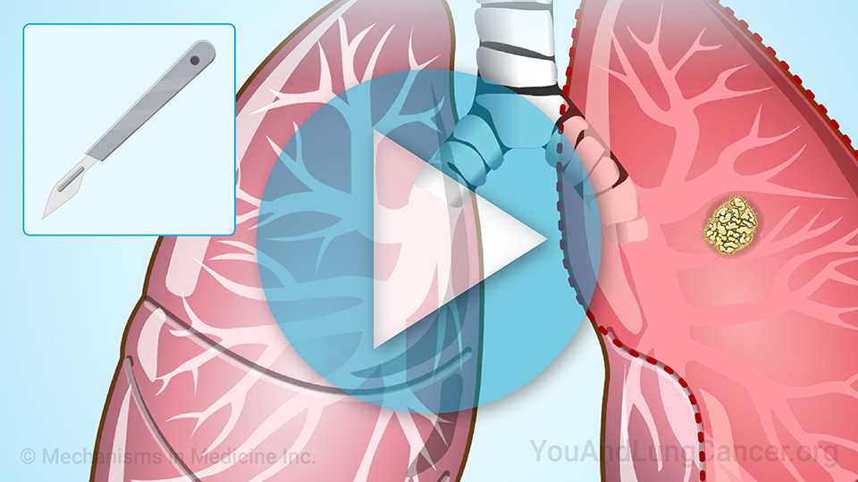 Understanding Lung Cancer Surgery and Rehabilitation
