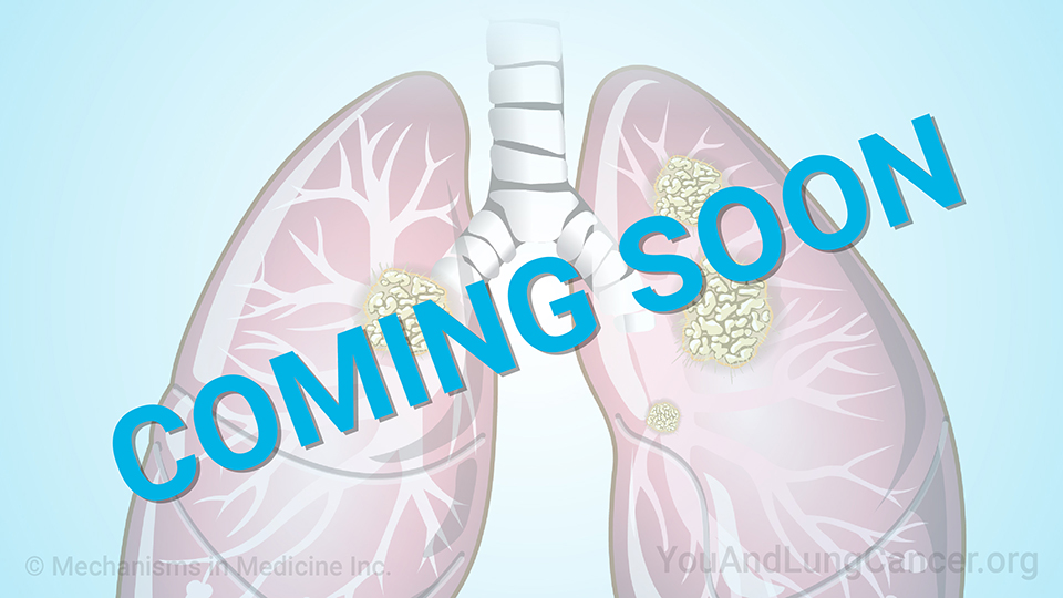 Animation - Understanding Non-Small Cell Lung Cancer