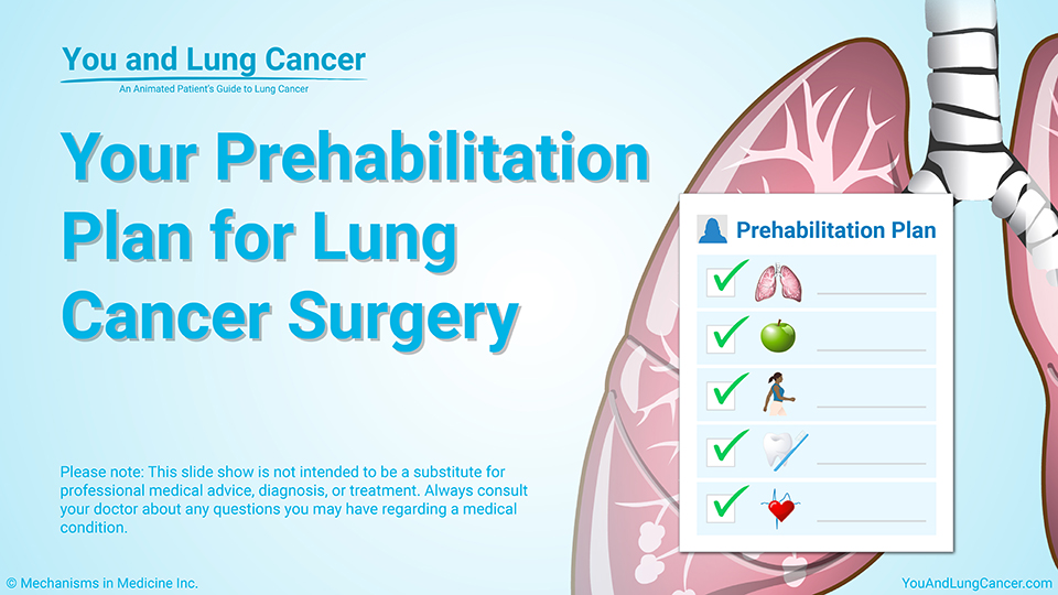 Your Prehabilitation Plan for Lung Cancer Surgery