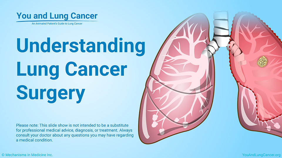 Slide Show - Understanding Lung Cancer Surgery and Rehabilitation